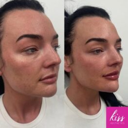 Facial Transformation including Cheek Filler with Dermal Filler at Kiss Aesthetics