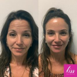 Forehead Lines Botox Treatment