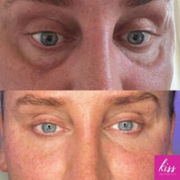 Tear trough filler to fill dark circles at Kiss Aesthetics UK clinics