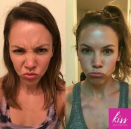 Frown Lines Botox Treatment