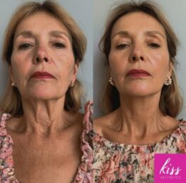 Plasma Bands Anti-Ageing Treatment