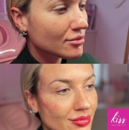 Facial Contouring with Cheek Filler at Kiss Aesthetics