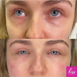 Under-eye filler to target under-eye bags in Ascot Aesthetics Clinic Kiss