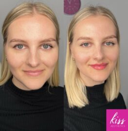 Natural Looking Lip Filler Results
