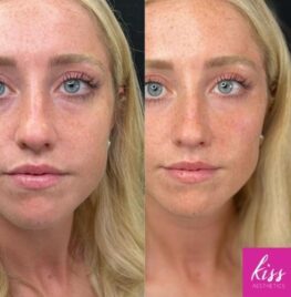 Cheek Filler by Antonia Knowles at Kiss Aesthetics in Ascot