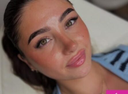Lip Filler Enhancement in Essex at Kiss Aesthetics