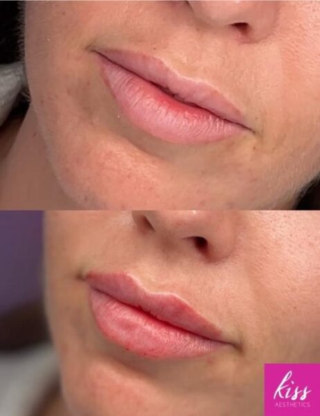 Natural Looking Dermal Filler Before and After Results