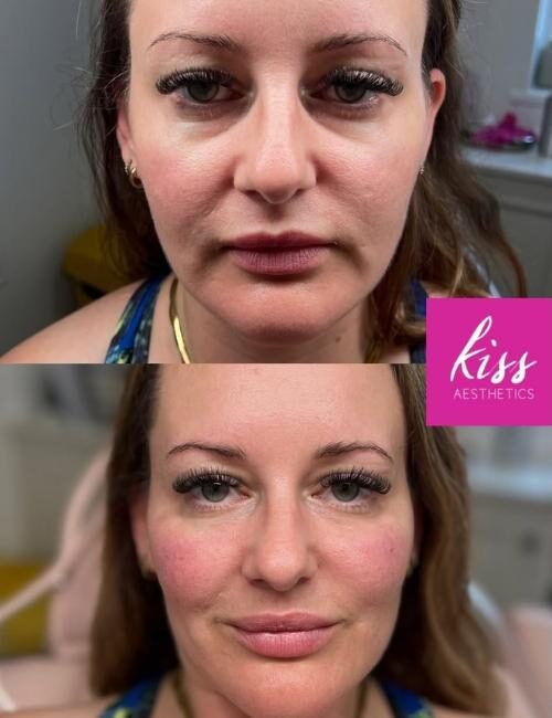 Tear Trough filler results at Kiss Aesthetics in Ascot