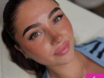 lip-fillers-in-essex-by-kiss-aesthetics Lip Filler Enhancement in Essex at Kiss Aesthetics