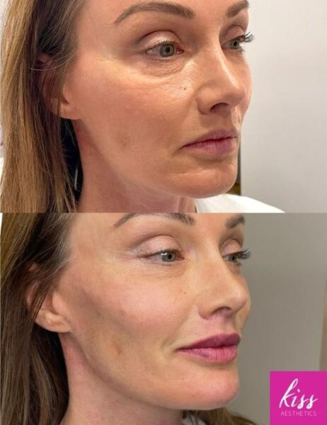 cheek-filler-before-after-results-kiss Subtle Cheek Filler to Restore Volume Loss by Kiss Aesthetics