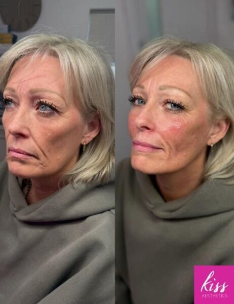 profhilo-structura-before-and-after-by-kiss-aesthetics Profhilo Structura Before and After from Kiss Aesthetics in Ascot