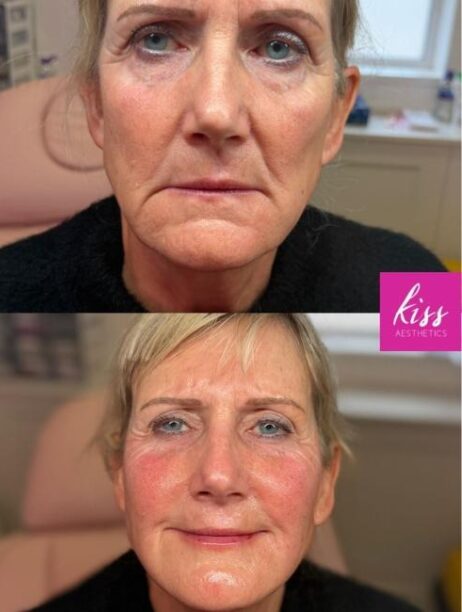 sculptra-before-and-after-by-kiss-aesthetics-ascot Sculptra Treatment Before and After Results from Kiss Aesthetics