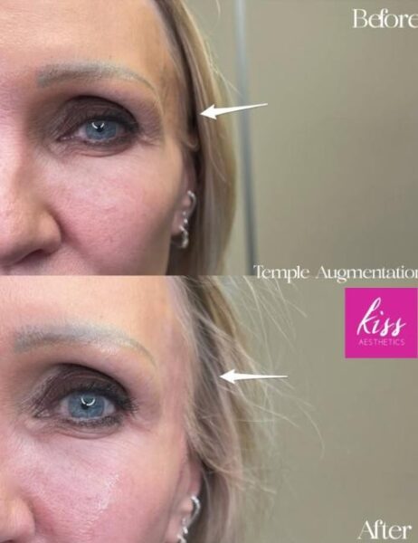 temple-filler-before-and-after-from-kiss-aesthetics-ascot Temple filler before and after by Kiss Aesthetics in Ascot UK