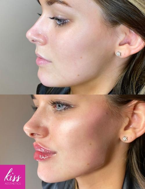 cheek-filler-before-after-results-kiss-aesthetics Cheek Filler Results as Part of a Transformation Package as Kiss Aesthetics Clinic