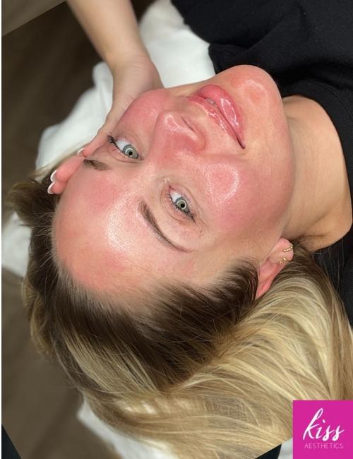 skin-hydration-treatment-kiss-ascot Glowing skin after treatment as Kiss Aesthetics in Ascot