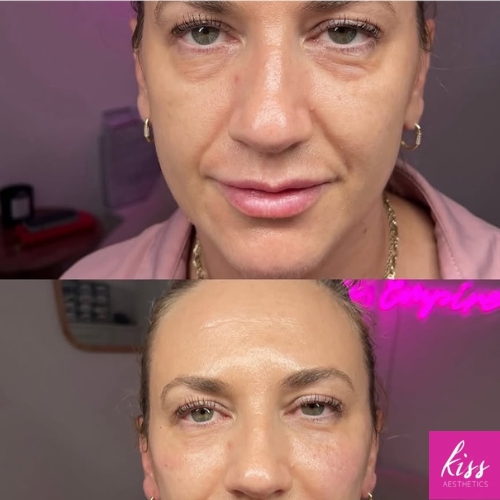 Tear trough filler before and after results from Kiss Aesthetics UK in Ascot