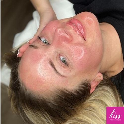 Anti-Wrinkle Treatment Combined With Skin Treatment in Essex at Kiss Aesthetics