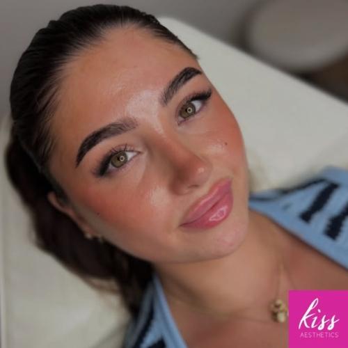 lip-fillers-in-essex-by-kiss-aesthetics Lip Filler Enhancement in Essex at Kiss Aesthetics