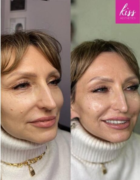 skin-booster-treatment-before-and-after-results-kiss-aesthetics Skin booster before and after results from Kiss Aesthetics in Ascot