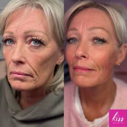 under-eye-filler-for-volume-loss